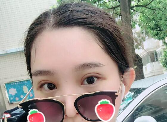 鄭州蕾娜斯彭沖醫(yī)生做微創(chuàng)雙眼皮效果怎么樣？微創(chuàng)雙眼皮案例效果展示