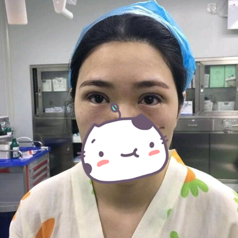 做完雙眼皮手術的幾天