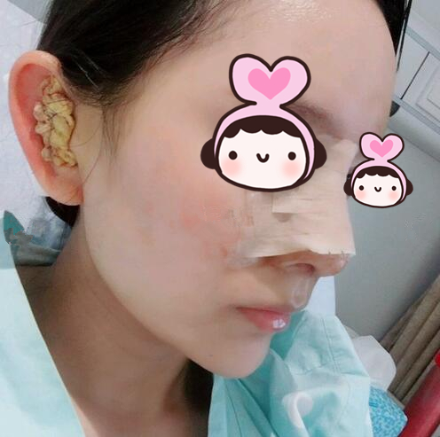 廈門(mén)海峽整形專(zhuān)家王翼耕做隆鼻案例分享