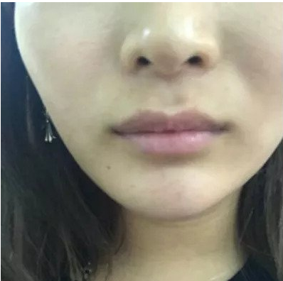 岳陽春天整形專家蔣正華做玻尿酸豐唇怎么樣？蔣正華玻尿酸豐唇案例分享