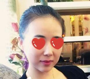 上海美萊醫(yī)生熊師做玻尿酸隆下巴怎么樣，熊師玻尿酸隆下巴案例分享