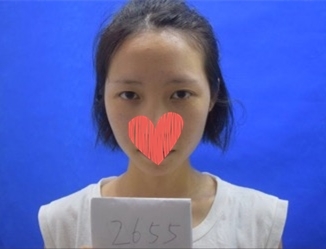 北京美萊整形專家杜園園開外眼角怎么樣？杜園園開外眼角案例效果對(duì)比圖