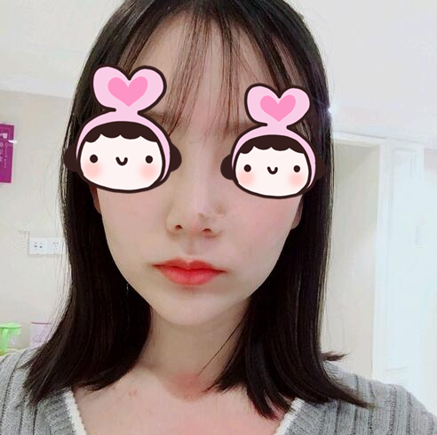 廈門海峽整形專家王翼耕做隆鼻的心得體會(huì)，王翼耕做隆鼻效果怎么樣？
