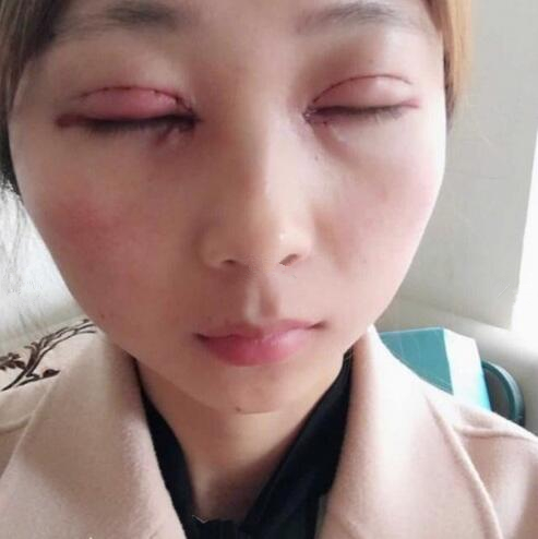 淄博美聯(lián)臣醫(yī)療美容醫(yī)院做切開雙眼皮怎么樣？切開雙眼皮案例分享