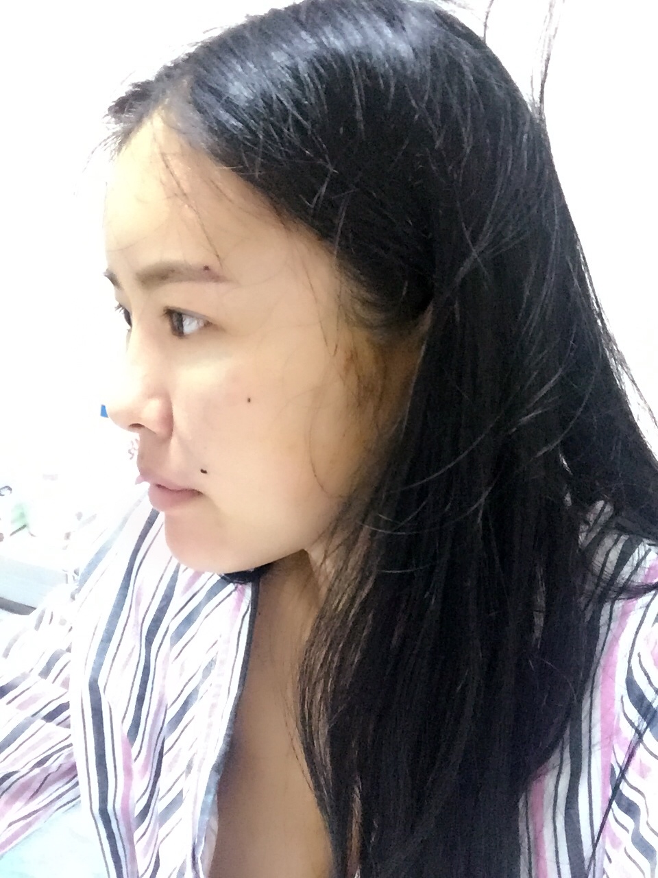 西安莎曼妃醫(yī)療美容醫(yī)院醫(yī)生樸俊做自體脂肪豐太陽(yáng)穴效果怎么樣?