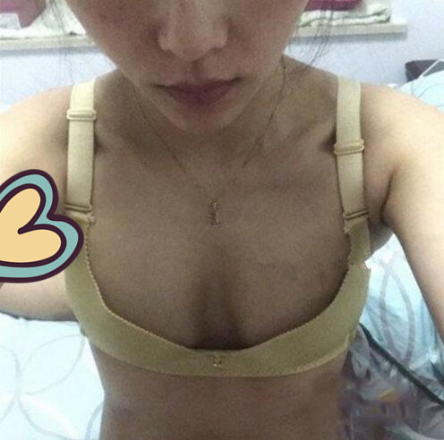 廣州駐顏光醫(yī)療美容診所整形專家劉培做復(fù)合隆胸技術(shù)怎么樣？附案例