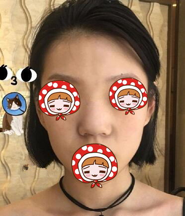 北京京韓醫(yī)療美容診所做硅膠隆鼻效果怎么樣？北京京韓醫(yī)療硅膠隆鼻案例