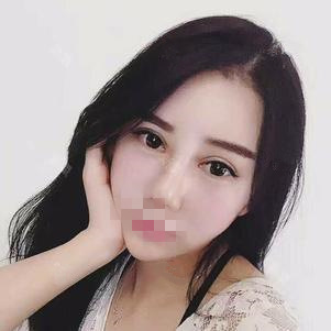 東莞維多利亞做硅膠隆鼻怎么樣？整形醫(yī)生李剛硅膠隆鼻案例分享
