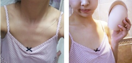 沈陽杏林整形美容醫(yī)院崔昌墉醫(yī)生做假體隆胸技術怎么樣？附案例