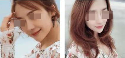 上海攸維醫(yī)療美容診所整形醫(yī)生李靜做膨體隆鼻效果怎么樣？附案例展示