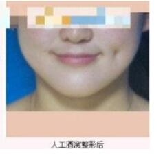 德州市第二人民醫(yī)院燒傷美容整形科張波濤醫(yī)生做酒窩成形術(shù)怎么樣？
