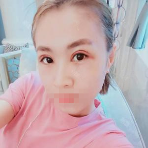 雙眼皮手術第二天