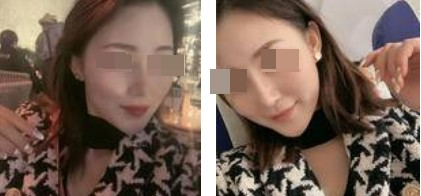 蘭州美月整形美容醫(yī)院文輝才醫(yī)生做鼻綜合整形效果怎么樣？附鼻綜合案例