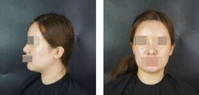 面部吸脂讓你做一個更受歡迎的精致“小臉”的女人