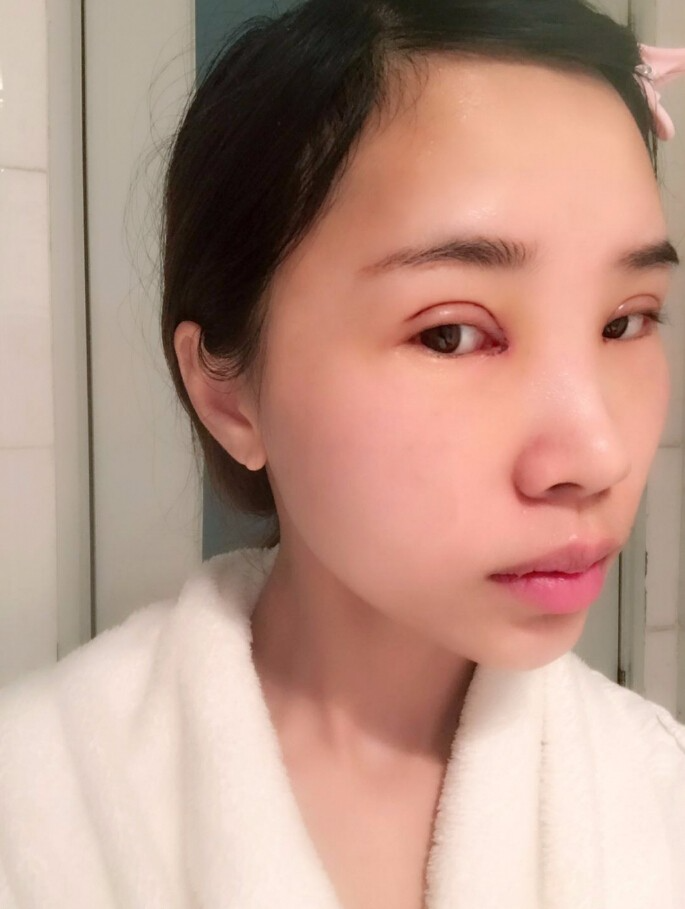 合肥艾雅整形美容醫(yī)院醫(yī)生楊海平做雙眼皮手術(shù)怎么樣？楊海平雙眼皮手術(shù)案例