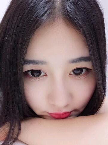 漢中韓美整形醫(yī)生常雙模假體隆鼻+耳軟骨墊鼻尖真實(shí)案例效果圖