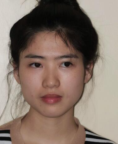 北京彤美整形醫(yī)院趙彤醫(yī)生做下頜角整形怎么樣？下頜角整形案例展示