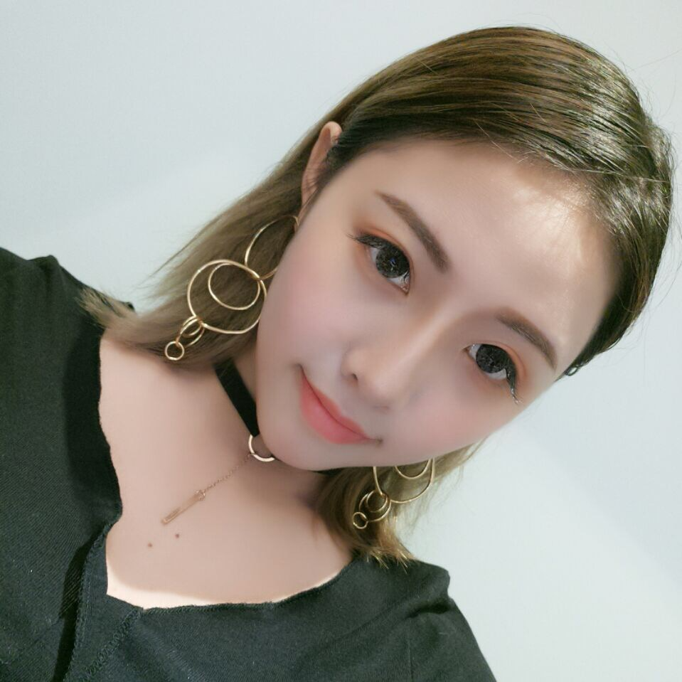 廣州中科美整形醫(yī)生徐長亮做切開雙眼皮怎么樣？附切開雙眼皮案例