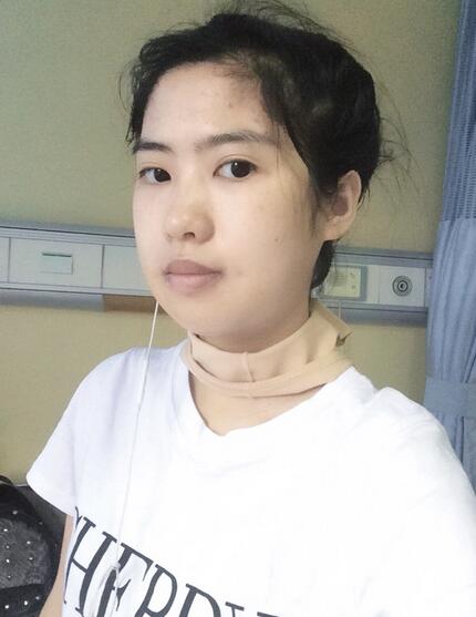 下頜角手術第八天