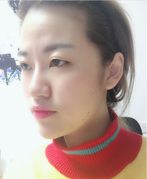 成都藝星醫(yī)療美容醫(yī)院陳遠(yuǎn)琨醫(yī)生做注射肉毒素瘦臉效果怎么樣？附案例