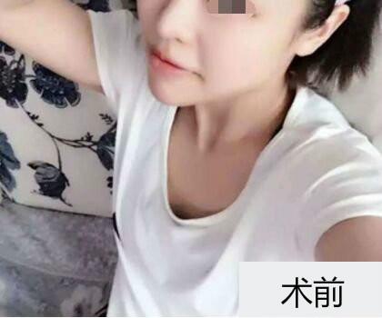 深圳博美整形醫(yī)生劉超做自體脂肪隆胸怎么樣？自體脂肪隆胸案例