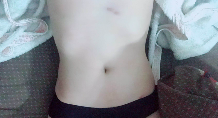深圳晨曦整形醫(yī)院吉米斯做腰腹吸脂怎么樣？附吉米斯醫(yī)生腰腹吸脂案例