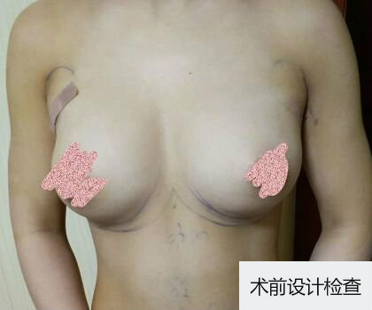 深圳博美整形醫(yī)生劉超做自體脂肪隆胸怎么樣？自體脂肪隆胸案例