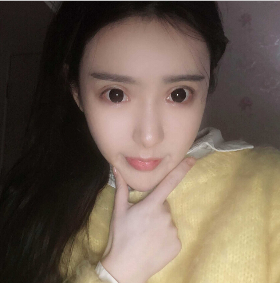 重慶柏漫醫(yī)療美容診所高紅艷醫(yī)生做面部吸脂怎么樣？面部吸脂案例分享