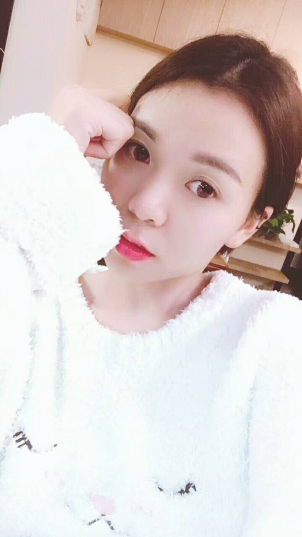 長沙星雅醫(yī)療美容醫(yī)院做埋線提升去法令紋效果怎么樣？附金振玉醫(yī)生案例