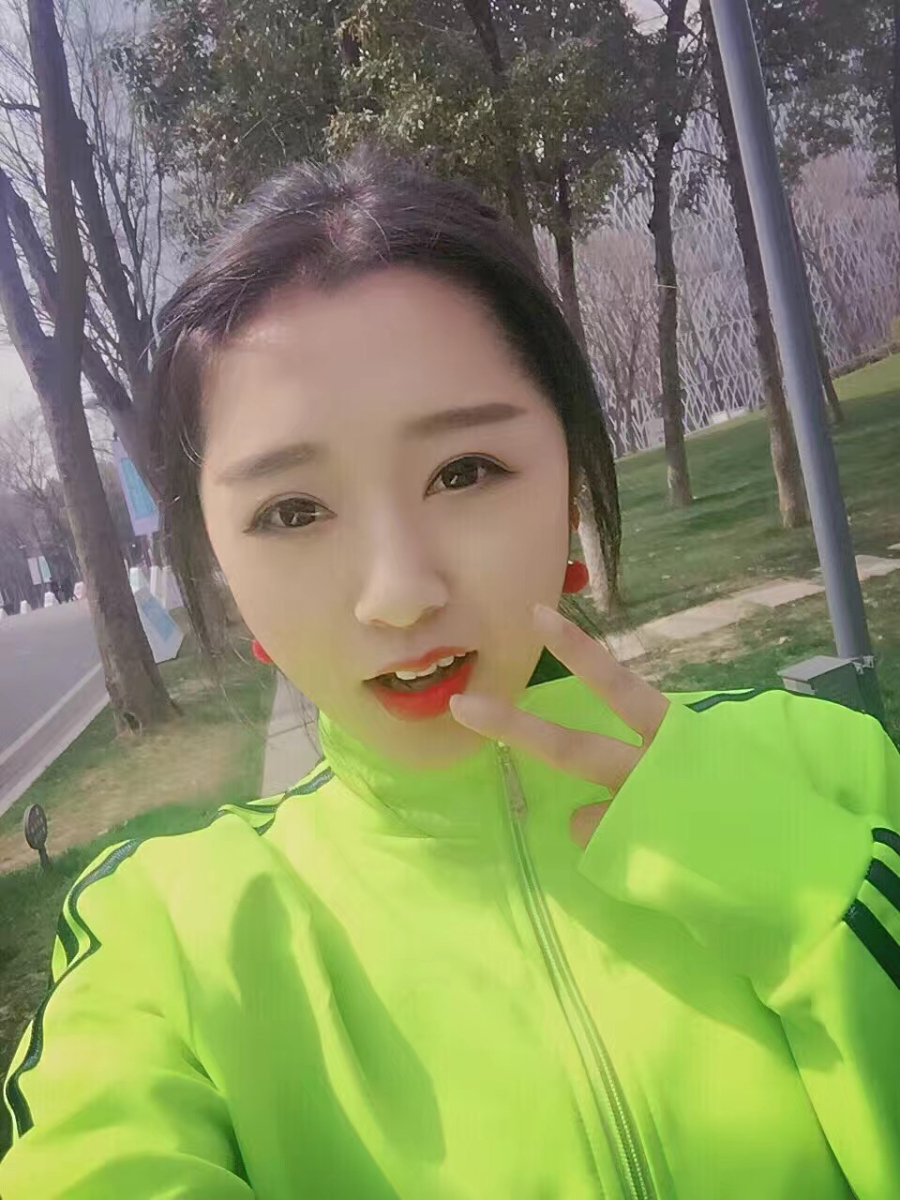 西安米蘭柏羽整形醫(yī)院李旭平做切開雙眼皮效果怎么樣？附案例