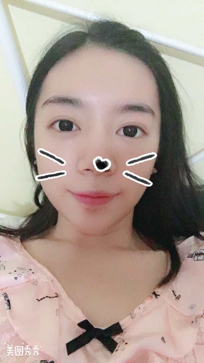 合肥壹加壹整形美容醫(yī)院做祛眼袋效果怎么樣？金大生祛眼袋案例分享