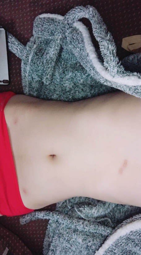 深圳晨曦整形醫(yī)院吉米斯做腰腹吸脂怎么樣？附吉米斯醫(yī)生腰腹吸脂案例