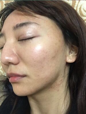 重慶柏漫醫(yī)療美容診所做激光祛痘效果怎么樣？白亞亞激光祛痘案例
