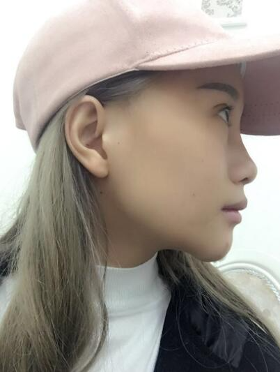 長(zhǎng)春奧拉克美容醫(yī)院金相勛醫(yī)生做玻尿酸豐臥蠶怎么樣？附案例