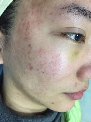 重慶柏漫醫(yī)療美容診所做激光祛痘效果怎么樣？白亞亞激光祛痘案例