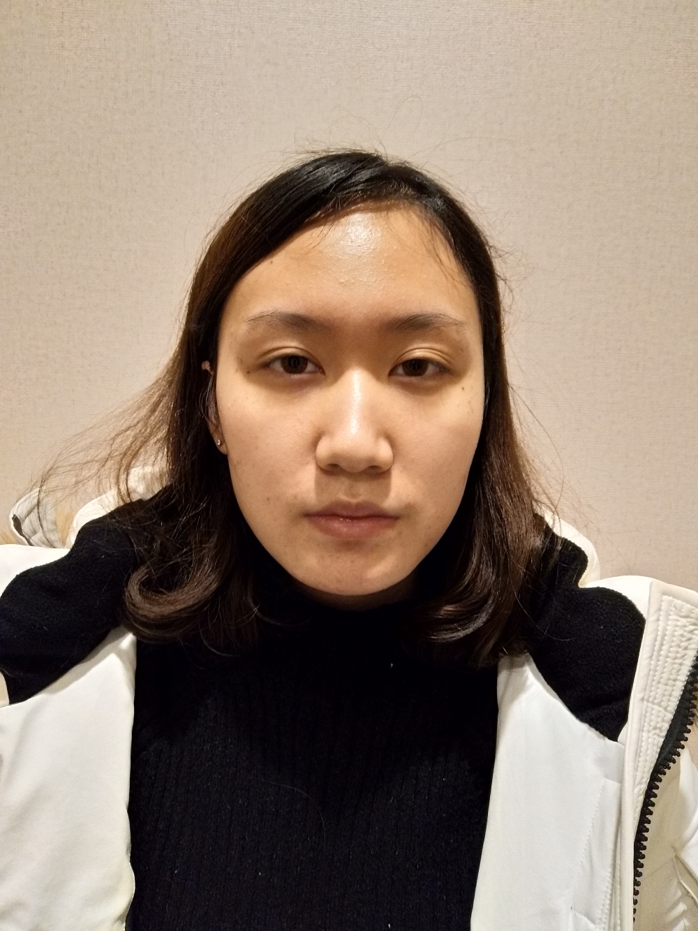 煙臺洛神醫(yī)學美容醫(yī)院張瑞允醫(yī)生做硅膠隆鼻怎么樣？附硅膠隆鼻案例