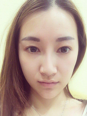 重慶五洲女子醫(yī)院整形美容中心做光子嫩膚怎么樣？淡明斌醫(yī)生光子嫩膚案例