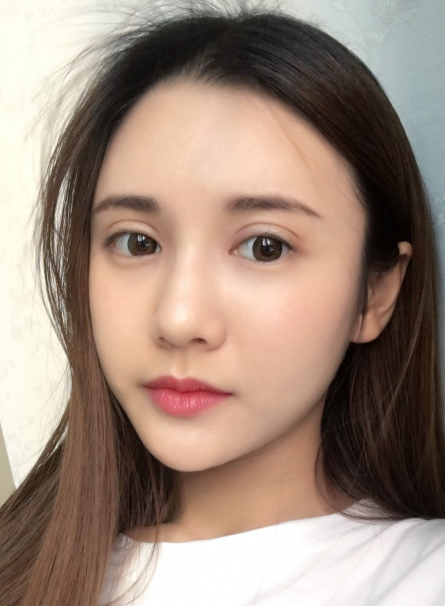 鄭州銘藝整形醫(yī)生陳濤做切開雙眼皮怎么樣？鄭州銘藝切開雙眼皮案例
