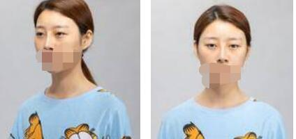 太原歐美蓮整形醫(yī)院丁曉峰醫(yī)生做雙眼皮怎么樣？丁曉峰雙眼皮手術案例分享