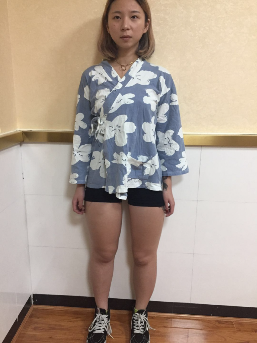 深圳鵬愛醫(yī)療整形醫(yī)生張建文做大腿吸脂怎么樣？附大腿吸脂案例效果對比圖