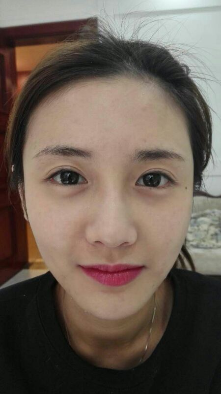 鄭州銘藝整形醫(yī)生陳濤做切開(kāi)雙眼皮怎么樣？鄭州銘藝切開(kāi)雙眼皮案例