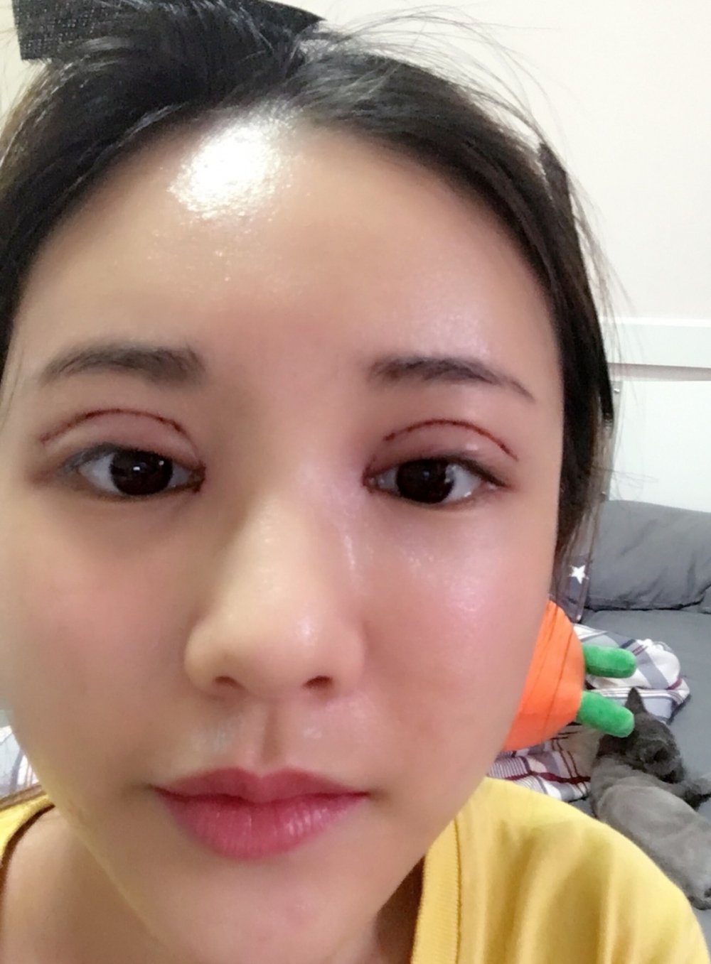 鄭州銘藝整形醫(yī)生陳濤做切開(kāi)雙眼皮怎么樣？鄭州銘藝切開(kāi)雙眼皮案例