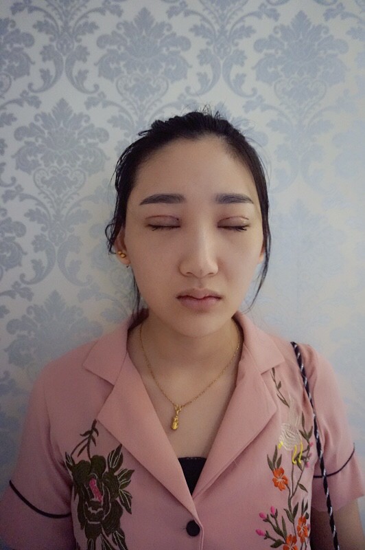 武漢中翰整形外科醫(yī)院沈磊醫(yī)生做切開雙眼皮怎么樣？附沈磊切開雙眼皮案例