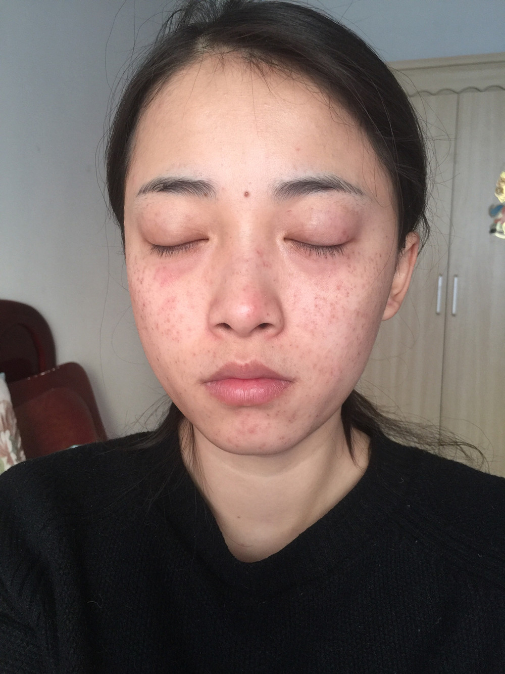 重慶當(dāng)代整形李敏旭醫(yī)生做皮秒激光祛斑效果怎么樣？附皮秒激光祛斑案例