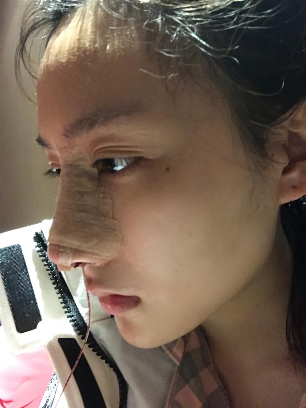 煙臺洛神醫(yī)學美容醫(yī)院張瑞允醫(yī)生做硅膠隆鼻怎么樣？附硅膠隆鼻案例