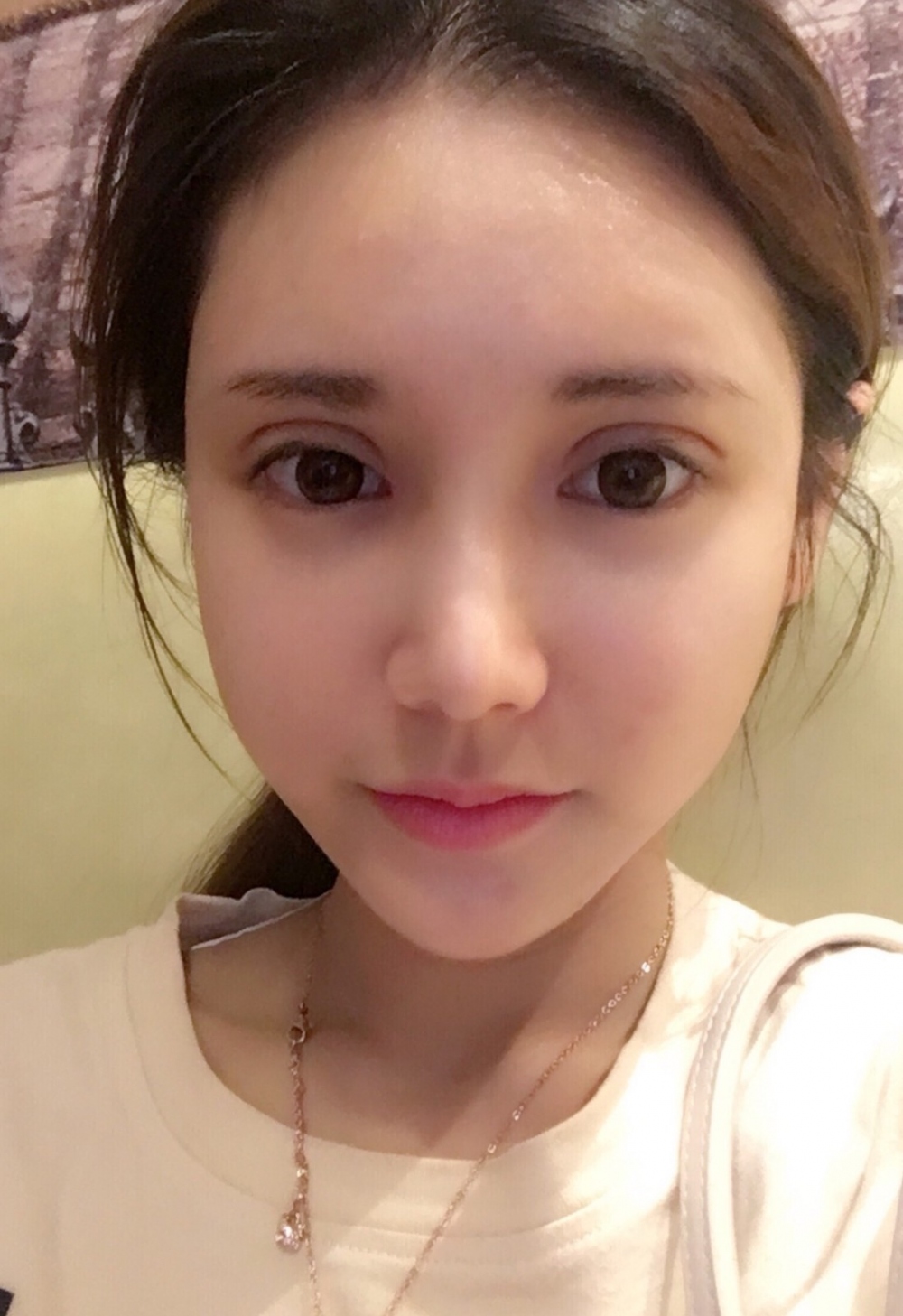 鄭州銘藝整形醫(yī)生陳濤做切開(kāi)雙眼皮怎么樣？鄭州銘藝切開(kāi)雙眼皮案例