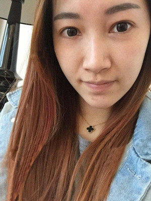 重慶五洲女子醫(yī)院整形美容中心做光子嫩膚怎么樣？淡明斌醫(yī)生光子嫩膚案例