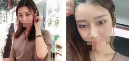 太原歐美蓮整形醫(yī)院丁曉峰醫(yī)生做雙眼皮怎么樣？丁曉峰雙眼皮手術案例分享