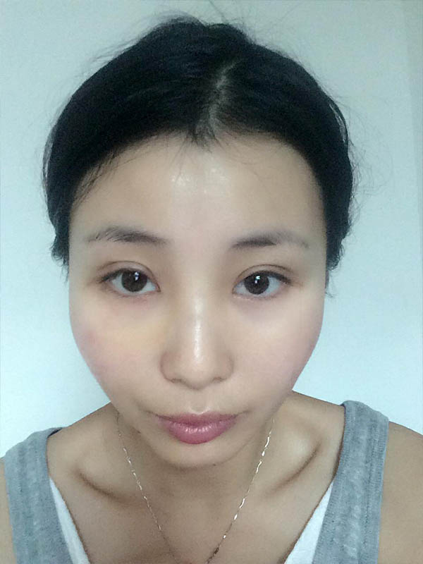桂林新華醫(yī)療美容醫(yī)生李新華做雙眼皮手術(shù)怎么樣？李新華雙眼皮手術(shù)案例