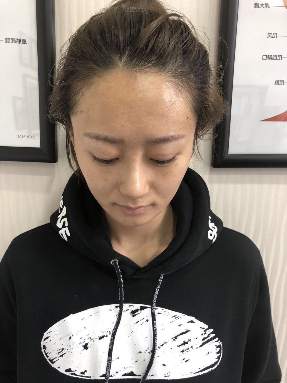 杭州迪美整形常德成醫(yī)生做鼻綜合整形技術(shù)怎么樣？附鼻綜合整形案例
